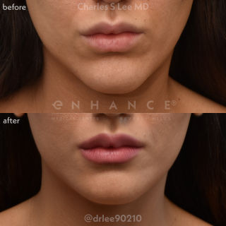 Chin Augmentation