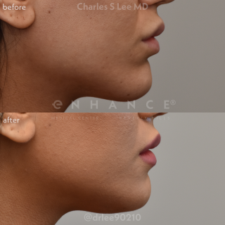 Chin Augmentation