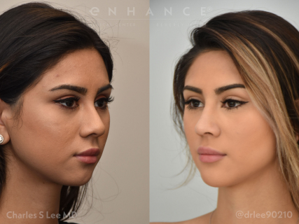 Rhinoplasty, chin implant, buccal pad removal and liposuction