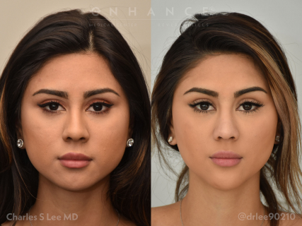 Rhinoplasty, chin implant, buccal pad removal and liposuction