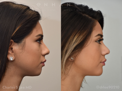 Rhinoplasty, chin implant, buccal pad removal and liposuction