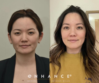 eyelid surgery