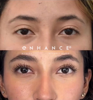 eyelid surgery
