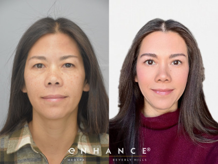 eyelid surgery