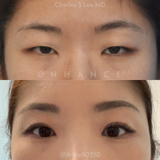 Eyelid Surgery