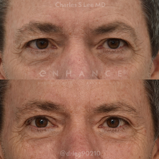 Eyelid Surgery