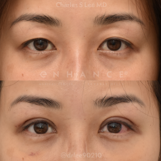 Eyelid Surgery