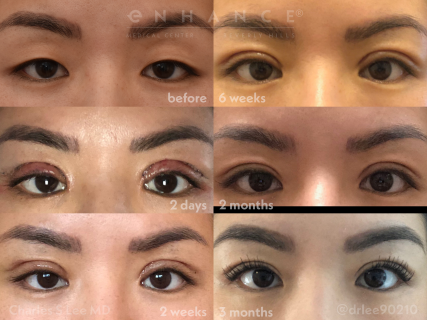 Eyelid Surgery