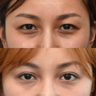 Eyelid Surgery