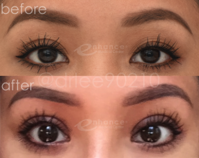 Eyelid Surgery