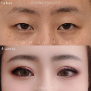 Eyelid Surgery