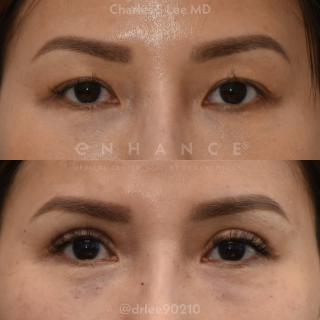 Eyelid Surgery