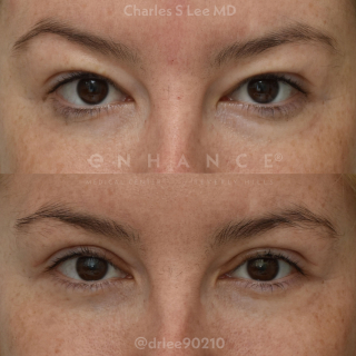 Eyelid Surgery