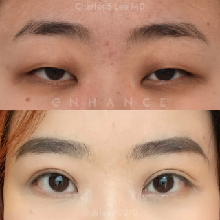 Eyelid Surgery