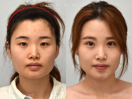 Eyelid Surgery