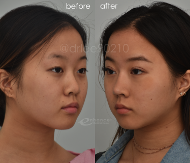Eyelid Surgery