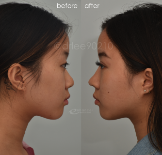 Eyelid Surgery
