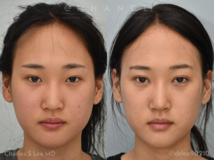 Eyelid Surgery