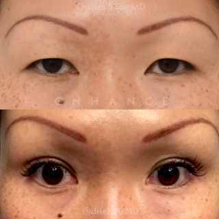 Eyelid Surgery