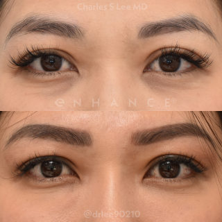 Eyelid Surgery