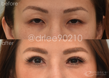 Eyelid Surgery