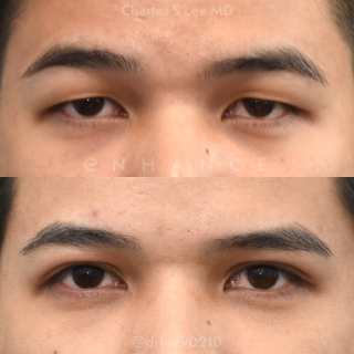 Eyelid Surgery