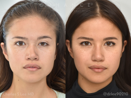 Rhinoplasty and Eyelid Surgery