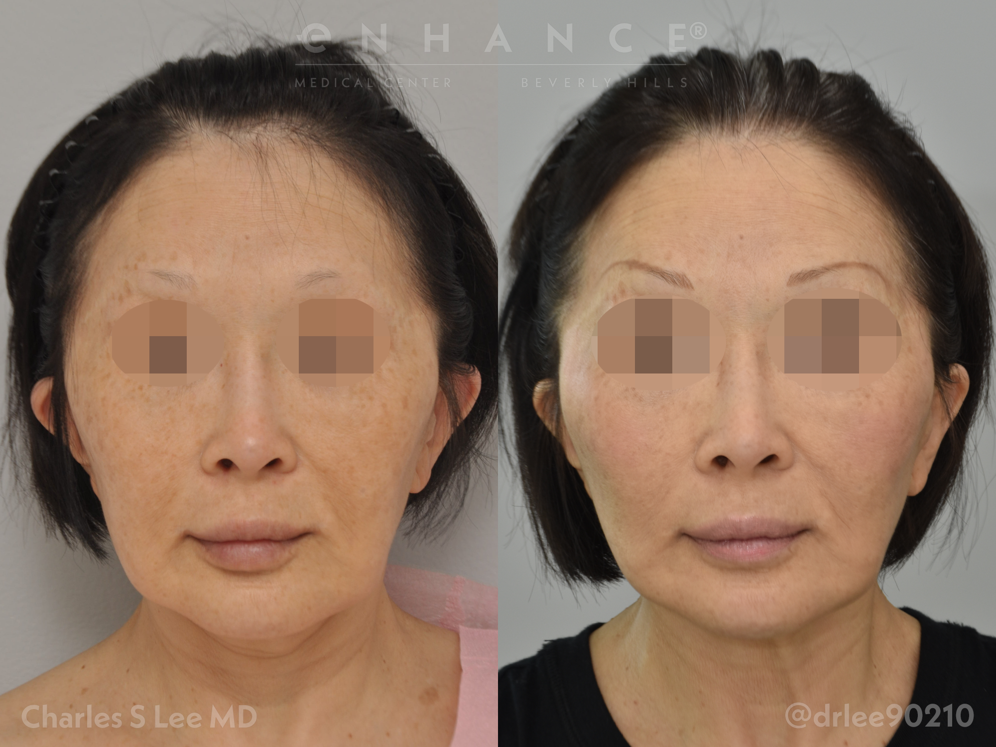 facelift photos