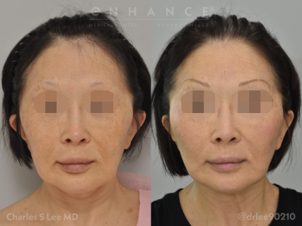 Facelift