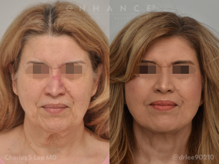 Facelift