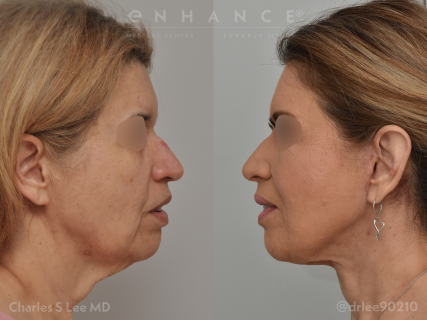 Facelift