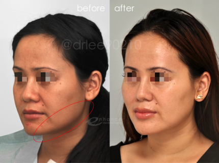 Jaw Reduction