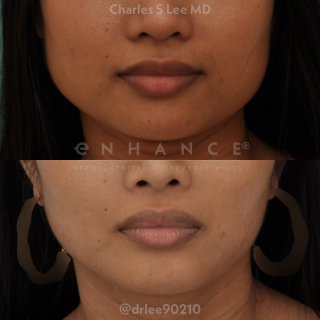 Jaw Reduction
