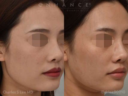 Jaw Reduction