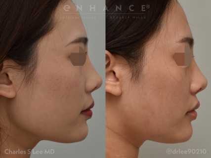 Jaw reduction photos