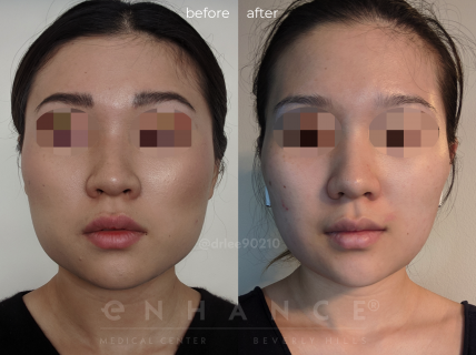 Jaw Reduction