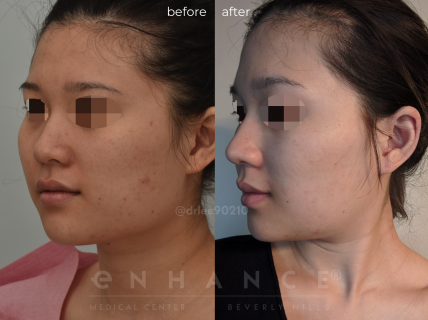 Jaw Reduction