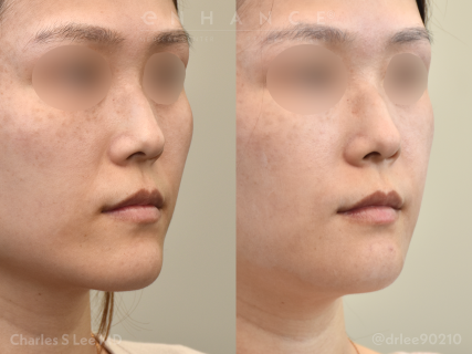 Jaw Reduction