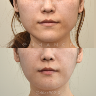 Jaw Reduction