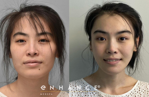 rhinoplasty, eyelids, brow lift, bone surgery