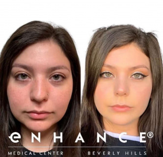 rhinoplasty