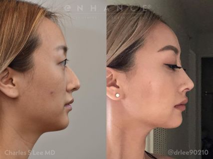 rhinoplasty