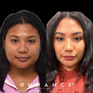 Rhinoplasty