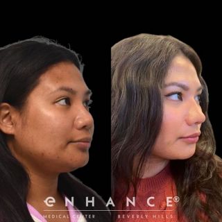 Rhinoplasty