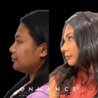 Rhinoplasty
