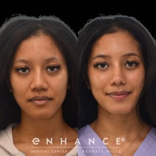 Rhinoplasty