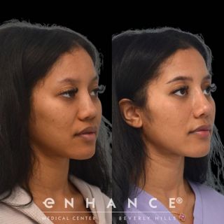 Rhinoplasty