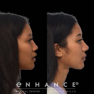 Rhinoplasty