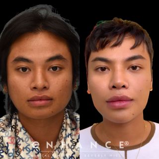 rhinoplasty with rib, chin implant, and jaw reduction