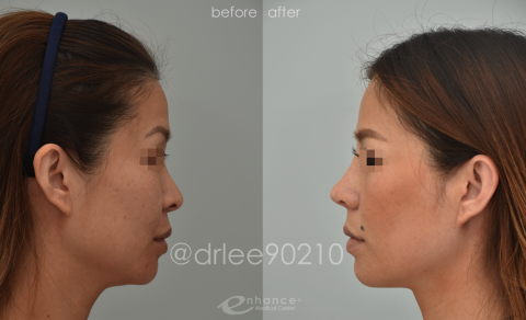Rhinoplasty